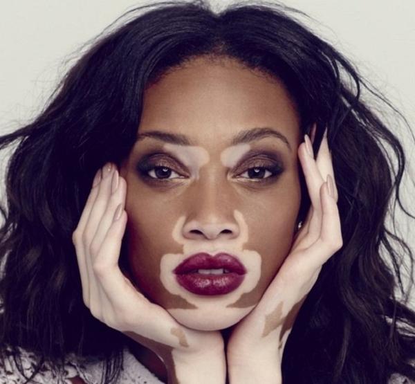 Vitiligo: Heilbar oder nicht?