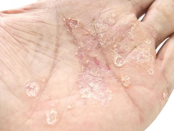 Kurzanleitung: Psoriasis und die Sonne