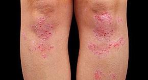 Psoriasis: Phototherapie-Behandlung und ihre verschiedenen Behandlungsarten